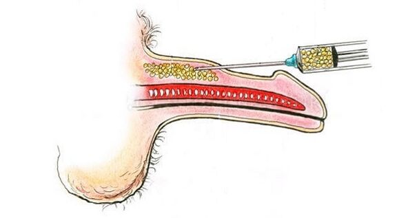 Injections d'acide hyaluronique dans le baril d'un membre pour l'augmenter